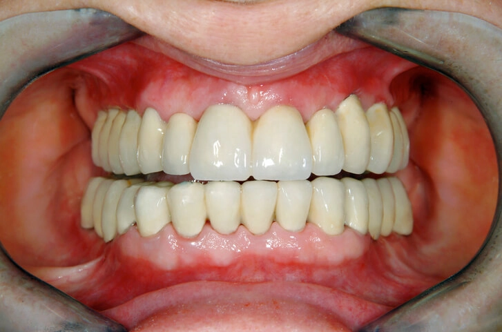 zdjęcie licówek zębowych