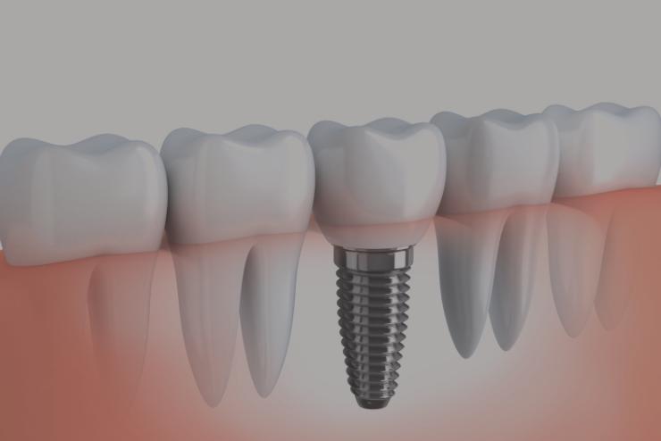 Implant zęba